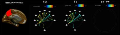 Decreased Functional Connectivity Between the Right Precuneus and Middle Frontal Gyrus Is Related to Attentional Decline Following Acute Sleep Deprivation